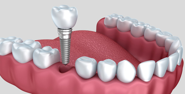 Advanced Dental Treatment At Smile Design By Ash